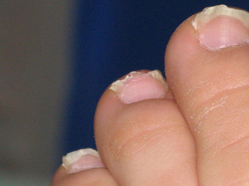 The nails lie on the nail bed. © Filip Malkovic, Wikimedia, CC by 2.0