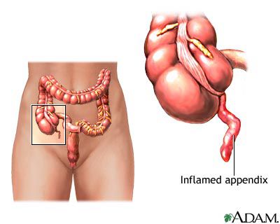 The ileo-caecal appendix is an outgrowth of the caecum, which may become inflamed. © www.health.allrefer.com