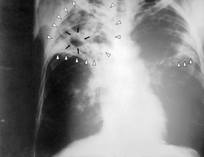 Tuberculosis is an infectious disease affecting the lungs. © DR