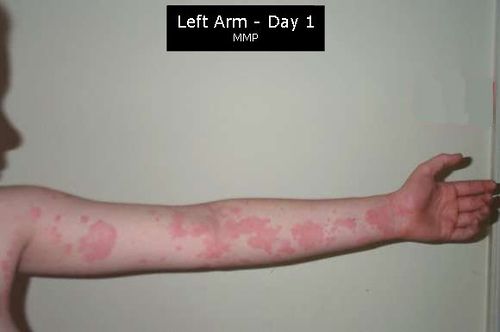 Urticaria reaction following allergy. © woofiegrrl CC by-nd 2.0