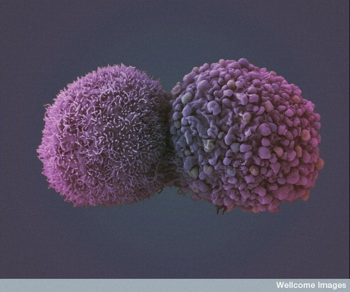 37610-cancercellulescancerpoumon-wellcome-imagesflickrccbynsdnc20