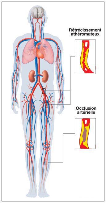 Arteritis mainly affects the lower limbs. © prevention-cardio.fr