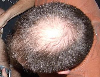 Alopecia means all forms of hair loss and can affect either sex. © Mike Burn, Flickr, CC by-sa 2.0