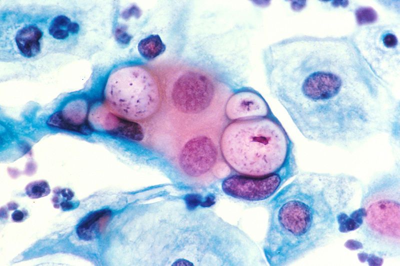 Chlamydia trachomatis is the bacterium responsible for Chlamydia infection. © Lance Liotta Laboratory