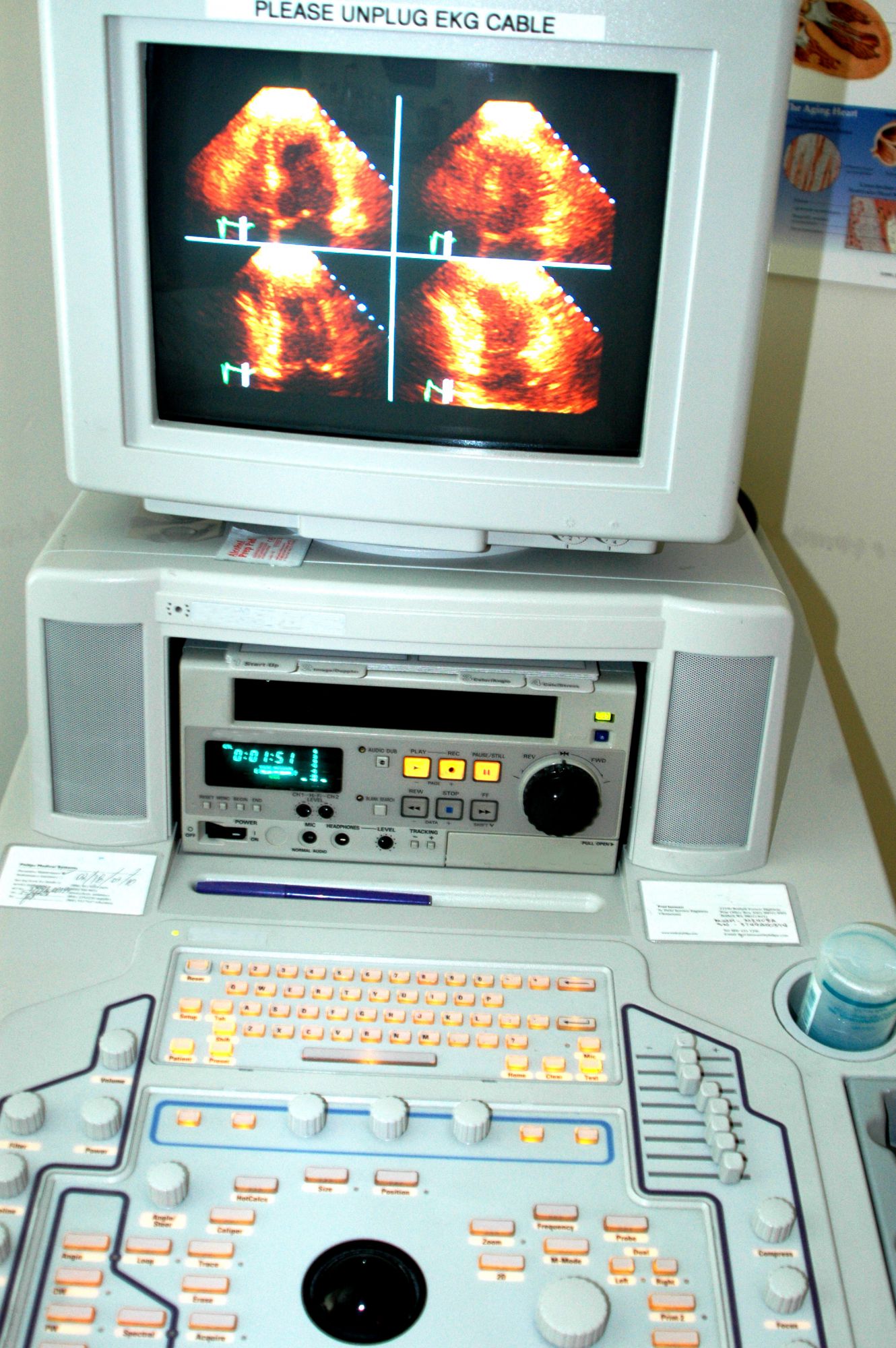 Echocardiography: an ultrasound of the heart.  © Robert Lerich