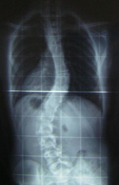 Scoliosis is a deformity of the vertebral column, sometimes pronounced. © Silverjonny, Wikimedia, public domain