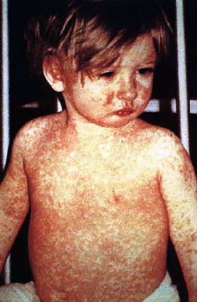 If not treated, measles can become a serious disease. © DR