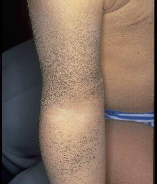 One of the forms of ichthyosis. © ULB