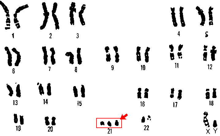 A karyotype (analysis of the chromosomes) is used to establish the presence of a supernumerary chromosome. © DR